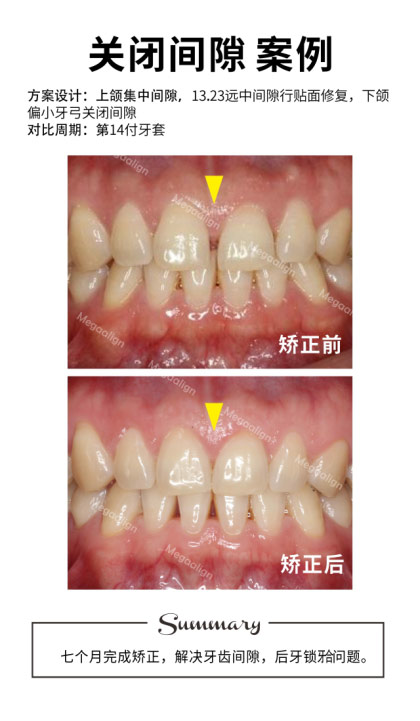 四個月完成矯正，解決輕微擁擠，扭轉(zhuǎn)牙齒，排齊牙列。