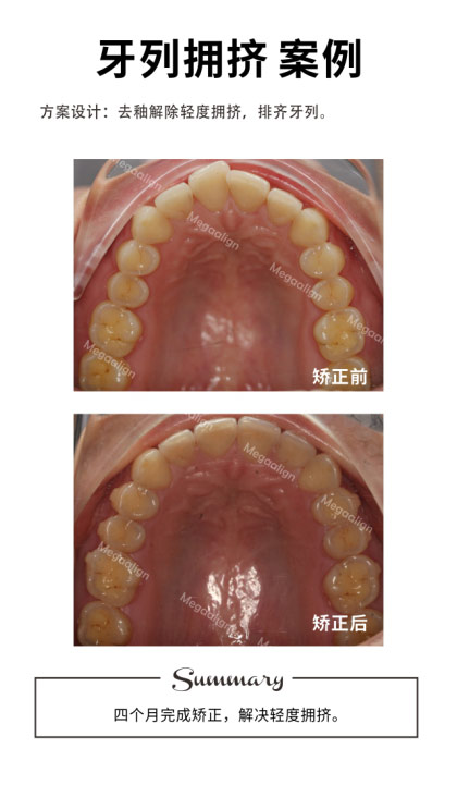 六個月完成矯正，解決輕度擁擠，深覆合問題。