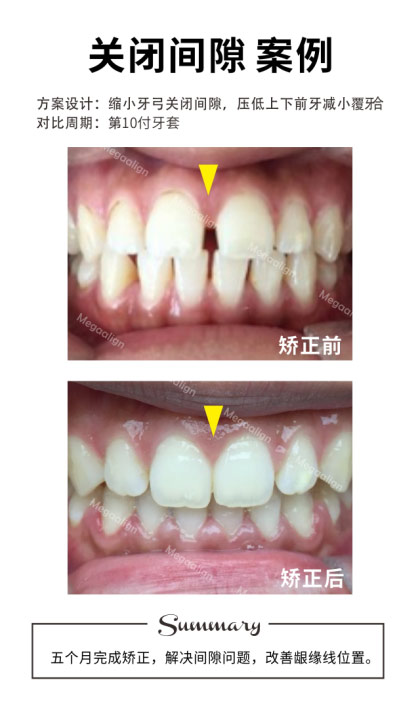 七個月完成矯正，解決前牙間隙，后牙鎖頜問題。