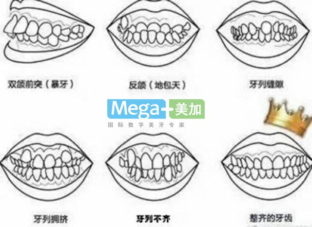 隱形矯正需要拔牙嗎