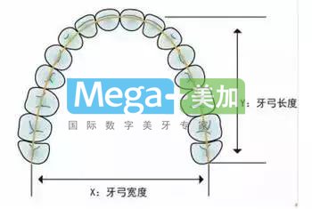 隱形矯正需要拔牙嗎