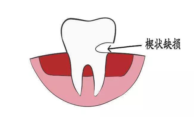 警惕，牙齒楔狀缺損不僅僅只是刷出來的！