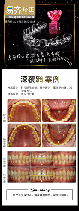 牙齒矯正對(duì)比圖