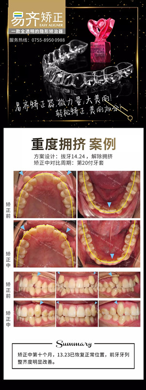 牙齒矯正對(duì)比圖