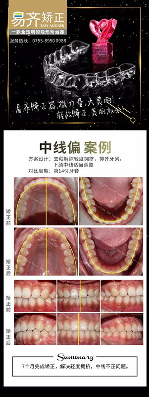 牙齒矯正案例