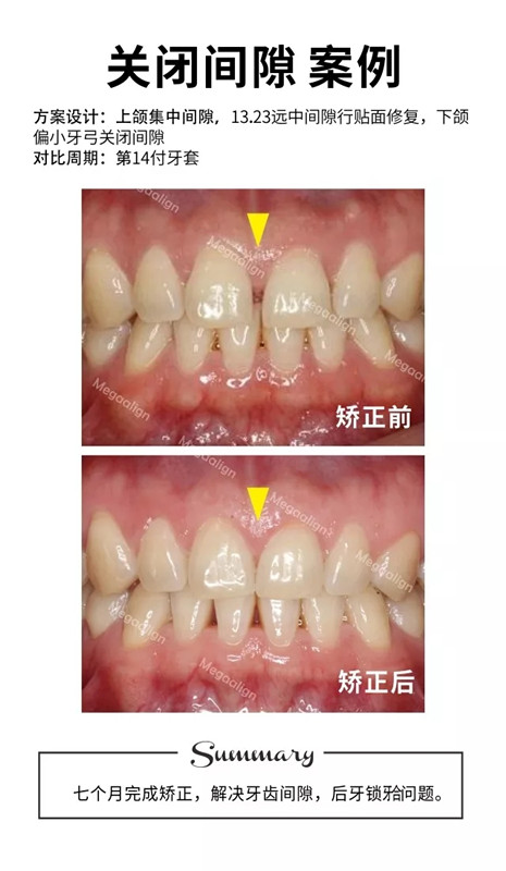 美加易齊隱形矯正案例