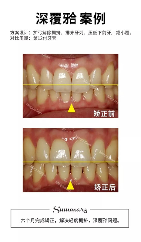 美加易齊隱形矯正案例