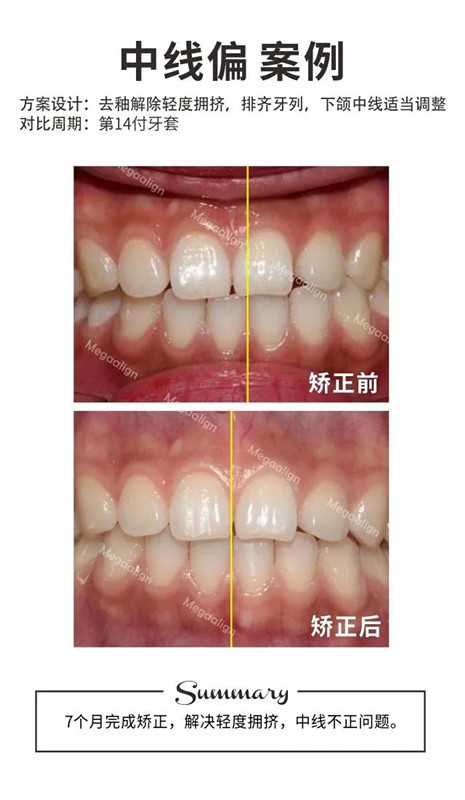 美加易齊隱形矯正案例