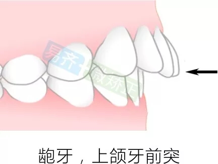 易齊微矯正方案：齙牙，上頜牙前突