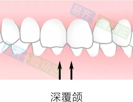 易齊微矯正方案：深覆頜