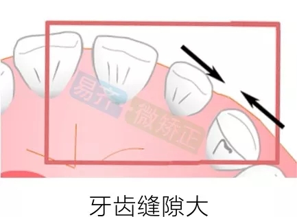 易齊微矯正方案：牙齒縫隙大