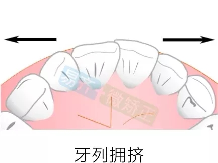 易齊微矯正方案：牙列擁擠