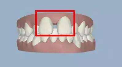 牙縫大是怎么回事呢