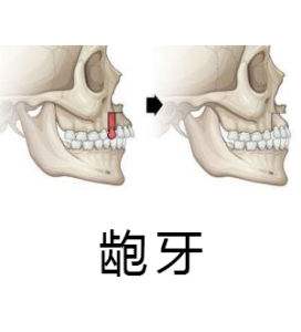 齙牙矯正有幾種方法