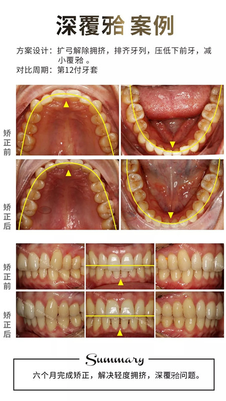 易齊隱形矯正案例