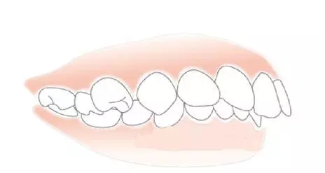 矯正齙牙方法