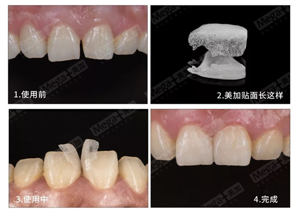 美加超薄美牙貼面