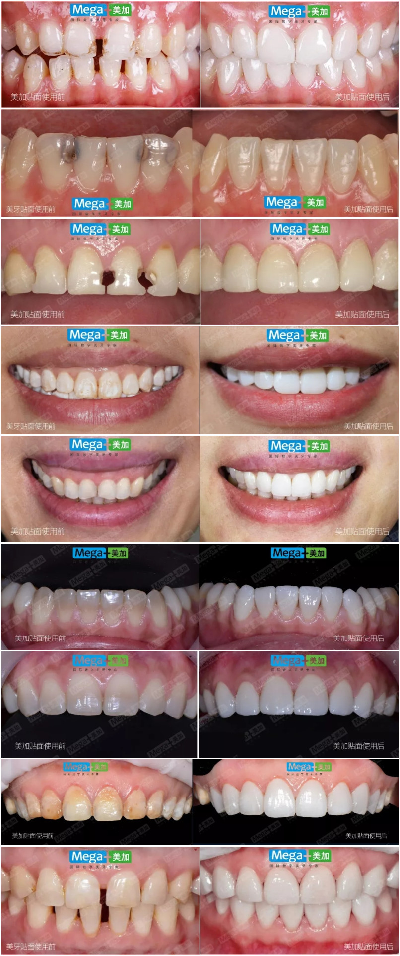 美加超薄美牙貼面案例