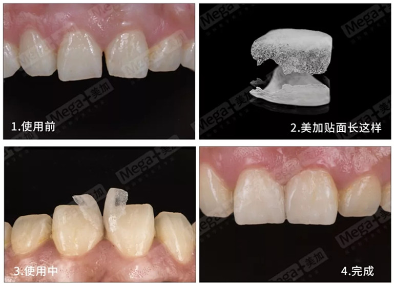 美加超薄美牙貼面