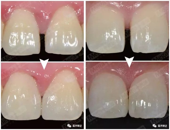 美加超薄美牙貼面關(guān)閉牙縫案例