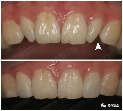 美加超薄美牙貼面關(guān)閉牙縫案例