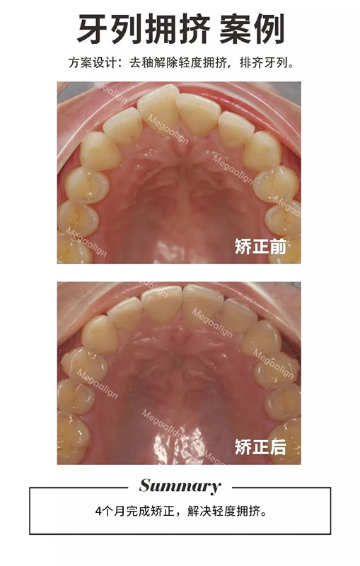 易齊微矯正案例集