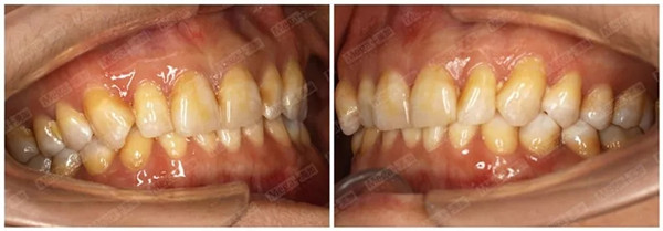 美加牙貼面氟斑牙案例-術前側面照