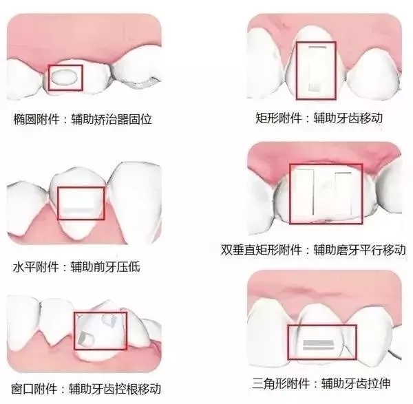 一分鐘了解透明牙套的隱形矯正原理！