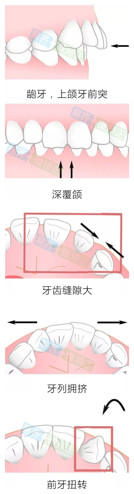 易齊矯正推出【微矯正】方案適應(yīng)癥