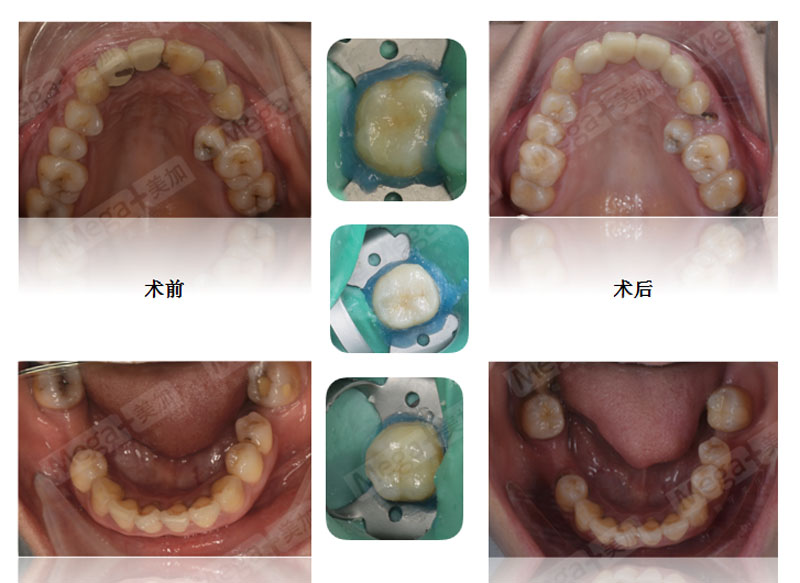 嵌體補(bǔ)牙