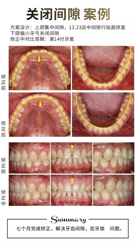 易齊隱形矯正關(guān)閉牙縫隙案例