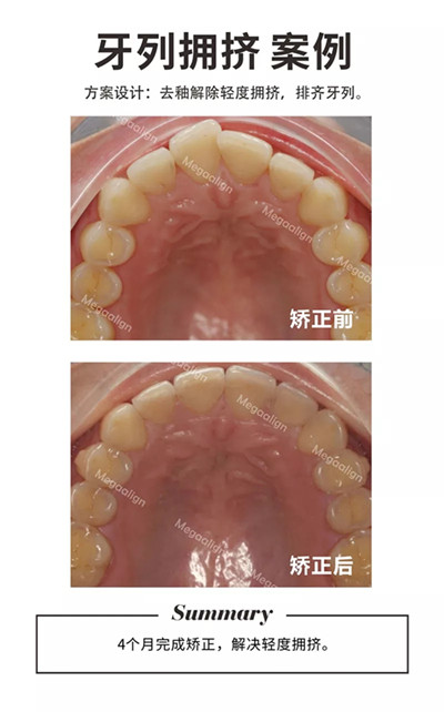 牙齒矯正-牙列擁擠案例