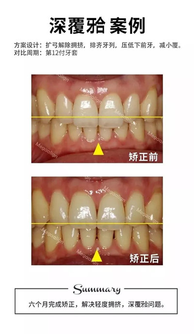 隱形矯正-深覆合案例