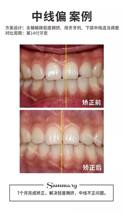 隱形矯正-中線偏案例