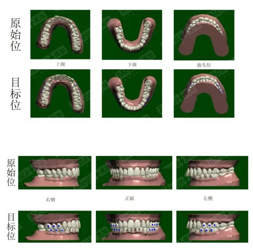 矯正方案設(shè)計(jì)