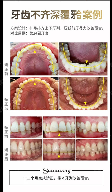 牙齒不齊深覆頜案例