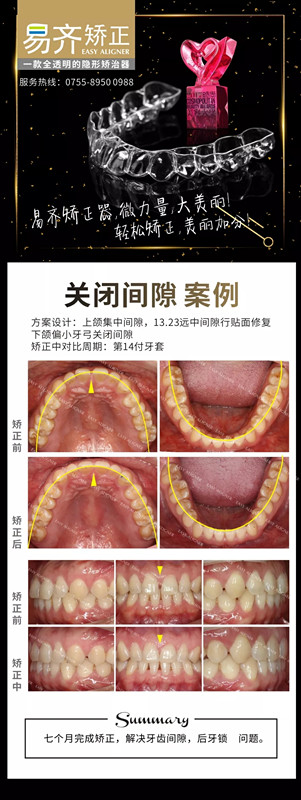 美加易齊透明矯正關(guān)閉牙縫案例