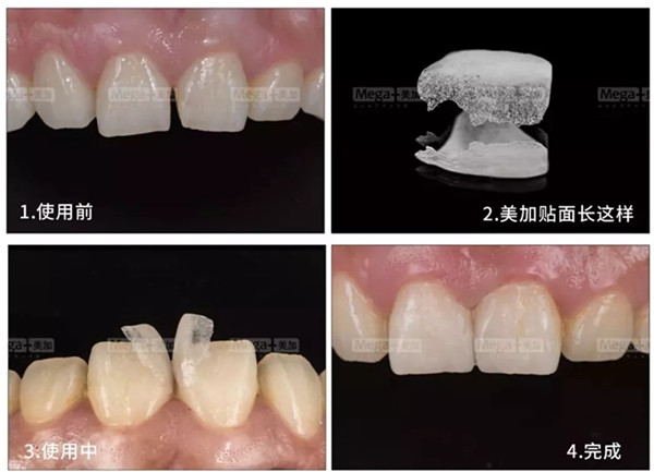 美加超薄美牙貼面