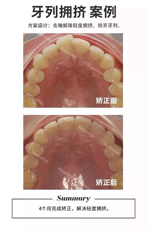 易齊微矯正案例分享