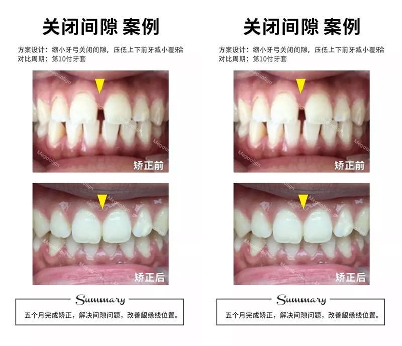 美加隱形矯正案例