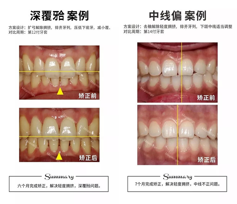 美加隱形矯正案例