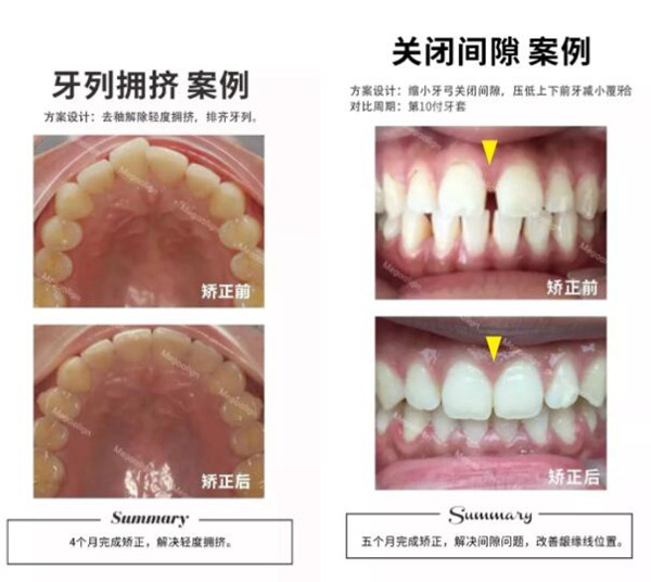 微矯正大改變