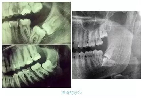 藏在牙槽骨內(nèi)的智齒
