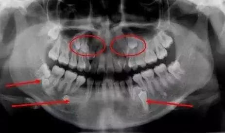 藏在牙槽骨內(nèi)的智齒