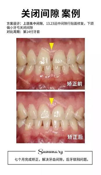 美加易齊隱形矯正關(guān)閉牙縫案例