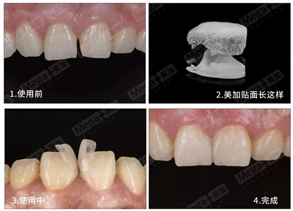 美加超薄美牙貼面