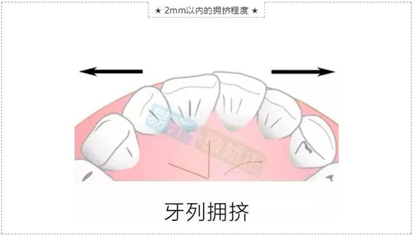 牙列擁擠