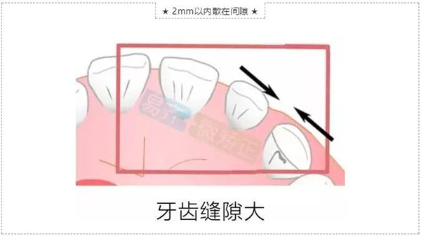 牙齒縫隙大