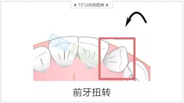 前牙扭轉(zhuǎn)