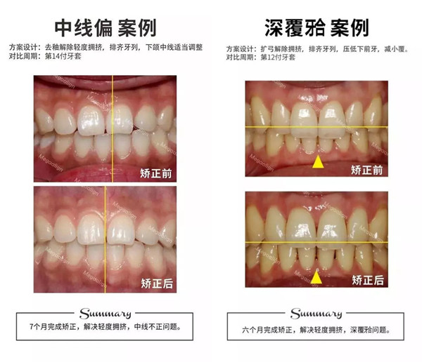 美加易齊微矯案例